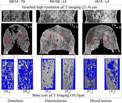 CT-based finite element simulating spatial bone damage accumulation predicts metastatic human vertebrae strength and stiffness